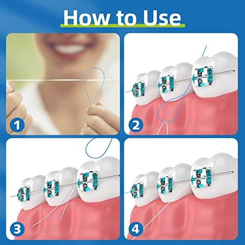 Нитевдеватели за зъбни конци, незаменим инструмент за поддържане на здравето на устната кухина при използване на скоби, стоматологичен